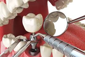 تبلیغات موثر برای ایمپلنت و ارتودنسی برای دندانپزشک ها