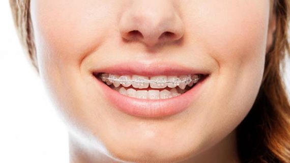 آشکار سازی دندان نهفته برای ارتودنسی